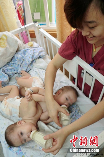 出生五個(gè)月的聯(lián)體女嬰在上海成功分離(圖)